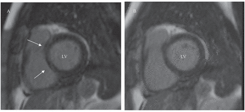 Figure 1. Cardiac magnetic resonance images of a 57-year-old patient with early RA. (A) Short-axis view of the heart showing linear late gadolinium enhancement (LGE) of the basal interventricular septum, segments 2–3 (arrows), at baseline imaging. (B) At follow-up imaging, LGE had cleared. LV, left ventricle