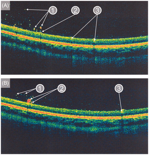 Figure 4. Optical coherence tomography images taken in January 2012 (A, B) showing (1) intravitreal, (2) preretinal, and (3) intraretinal (in the nerve fiber layer) locations of the deposits in the presented patient with Gaucher disease type 3.