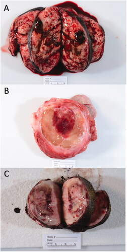 Figure 3. Gross images of 3 different representative treated tumor samples. Grossly, treatment areas were generally characterized by discrete foci of hemorrhage and tissue softening as seen in images (A and B). In some samples, treatment areas were less discrete and characterized by pallor with a rim of hemorrhage as seen in image (C).