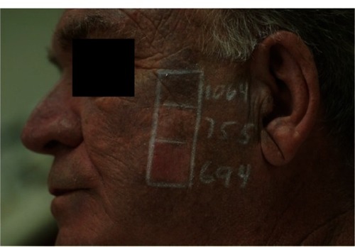 Figure 3 Diffuse blue-black darkening after prolonged minocycline use.