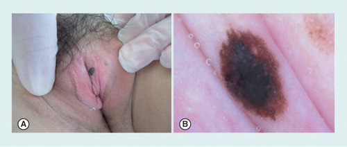 Figure 4. Compound melanocytic nevus of the genital area in a 13-year-old girl.(A) Clinical image showing a dark brown macule on the labia. (B) On dermoscopy, the lesion shows a mixed pattern with a homogeneous brown pigmentation and a central blue–grey area.