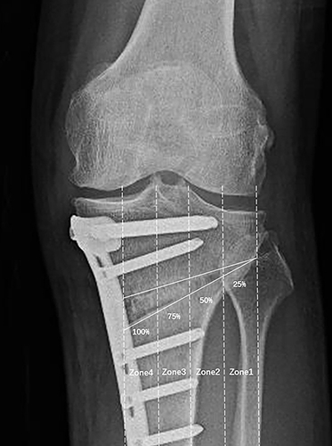 Figure 2 The osteotomy space was divided into the lateral hinge and four equally spaced intervals on the medial-lateral radiograph of the knee joint.