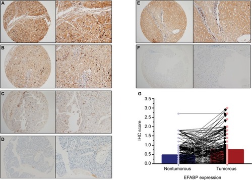 Figure 1 Epidermal fatty acid-binding protein (EFABP) is expressed mainly in the cytoplasm.Notes: Representative images of heptatocellular carcinoma (HCC) tissues showing strong (A), moderate (B), weak (C), and negative (D) EFABP expression. Representative images of positive and negative EFABP expression in a nontumorous sample (E, F) (left panel: magnification 100×; right panel: magnification 400×). EFABP expression was increased in HCC tissues compared with that in the corresponding nontumorous tissue, as assessed by immunohistochemistry (IHC) (P<0.001) (G).