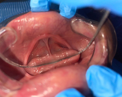 Figure 4 Vertical reduction of lower ridge with very adherent frenulum.