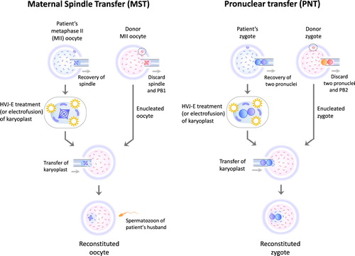 Figure 1. The procedures of maternal spindle transfer (MST) and pronuclear transfer (PNT). MST and PNT require oocytes donated from a third-party woman. The both reproductive procedures involve karyoplast biopsy and fusion of a karyoplast and a cytoplasm. After MST, most of the cytoplasm of a reconstituted oocyte derived from a patient’s oocyte is replaced with the cytoplasm of a donor oocyte. The cytoplasm of a reconstituted zygote is largely replaced with that of a zygote created using a donor oocyte and a spermatozoon of patient’s husband. HVJ-E: Hemagglutinating virus of Japan envelope, PB1: first polar body, PB2: second polar body.