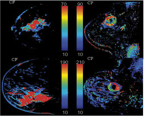 Figure 5. WiP maps generated from DCE-MRI that exemplify the type of enhancement noted in LABC patients: left column, centrifugal (CF), uniform enhancement from centre to periphery; right column, centripetal (CP), inhomogeneous ring-type enhancement.