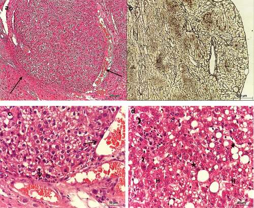 Figure 5. Photomicrograph of sections of liver of HCC control mice showing altered architecture of hepatic tissue. (a, c, & d) stained with Hx & E, (b) stained with silver nitrate. (a) shows the presence of nodules (arrows), (b) shows hepatic fibrosis and altered architecture, (c) shows the presence of unpaired arteries (arrows), and (d) shows pleomorphic hepatocytes (H), with strong eosinophilic cytoplasm and rounded nuclei with prominent nucleoli (arrowheads), along with macrovesicular steatosis (asterisks).