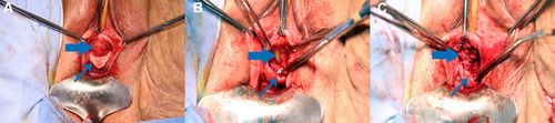 Figure 7 Images demonstrating diverticulectomy.