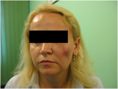 Figure 1 Swelling resulting from accumulation of fluid within the skin.