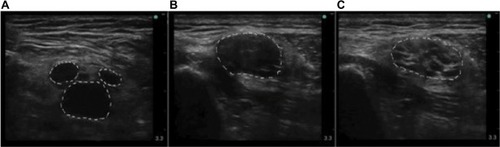 Figure 4 The variation of neuromas.