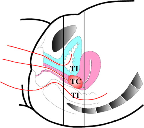 Figure 2. Intra-luminal temperature measurement. TC (tumour contact) is defined as close contact of the thermometry catheter with tumour; TI (tumour indicative) is defined as the position of the thermometry catheter ventral or dorsal of the tumour in the same transverse plane as the tumour but not in contact. Figure copied from Wielheesen et al. Citation[4], with permission of the author.