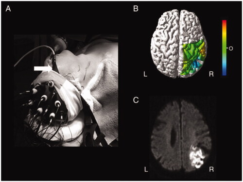 Figure 3. Multichannel NIRS optical topography perioperative stroke detection. (A) The placement of the optodes (OMM 2000) and the sensor (INVOS 3110 A) during surgery. White arrow indicates the sensor of the INVOS 3110 A. (B) Optical topographic maps demonstrate decreases in Oxy-Hb in the watershed zone between the MCA and PCA on the right side during cross-clamping of the ICA. The maps were overlaid on anatomical MRI surface images. C: Diffusion-weighted MRI shows high intensity regions corresponding to the area associated with the decrease of Oxy-Hb. Abbreviations: ICA, internal carotid artery; MCA, middle cerebral artery; Oxy-Hb, oxyhaemoglobin; PCA, posterior cerebral artery; OT, optical topography. [Reprinted from Nakamura et al. [Citation59] with permission from Elsevier].