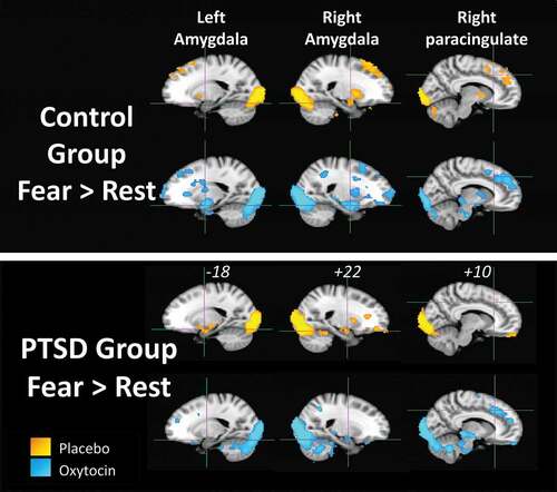 Figure 5. Results of the voxel-wise general linear model analysis for the Fear > Rest contrast for each participant group (PTSD and childhood trauma-exposed groups) and drug condition (yellow = placebo, blue = oxytocin). Activation is significant at a cluster-corrected threshold of Z > 2.33, p = .05. Crosshairs in each brain slice are centred on left amygdala, right amygdala or right paracingulate region. MNI x-coordinate is shown for each slice.