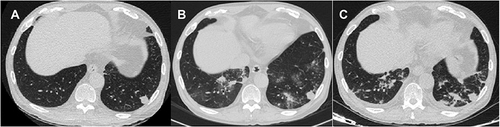 Figure 1 (A) (2019–10-18) Multiple nodules, patchy high-density shadows and glass high-density shadows were seen in both lungs. (B) (2019–10-23) Multiple nodules and patchy high-density shadows were present in both lungs. (C) (2019–10-30) Nodules and patchy shadows were seen in both lungs, and bilateral pleural effusion.