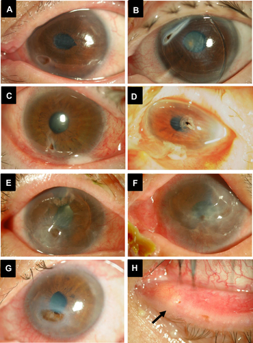 Figure 1 Slit lamp photographs of six cases of corneal perforation at presentation to our hospital. (A) Left eye of Case 1: Peripheral perforation is observed on the inferior nasal side with disappearance of the anterior chamber and iris depression. (B) Left eye of Case 2: Peripheral perforation on the superior nasal side with iris depression and disappearance of the anterior chamber. (C) Right eye of Case 3: Inferior temporal peripheral perforation with iris depression. (D) Left eye of Case 4: Temporal paracentral perforation with iris depression and disappearance of the anterior chamber. (E) Right eye of Case 5: Inferior temporal paracentral perforation with iris depression and disappearance of the anterior chamber. In addition, blood vessels invading a part of the cornea are observed. (F) Left eye of Case 5: Temporal paracentral perforation with iris depression and vascular invasion into the cornea and corneal opacity. (G) Left eye of Case 6: Inferior nasal paracentral perforation with iris depression and disappearance of the anterior chamber. (H) Same eye as in (G): Concretions in the lacrimal canaliculi are visible through the punctum (black arrow).