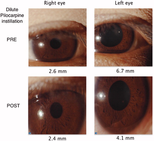 Figure 2. Denervation supersensivity test, after thirty minutes of one drop 0.125% pilocarpine, showed left pupil constriction from 6.7 to 4.1 mm.