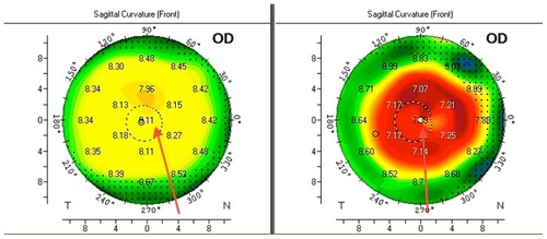 Figure 9 Preoperative and postoperative Scheimpflug-generated tomography.