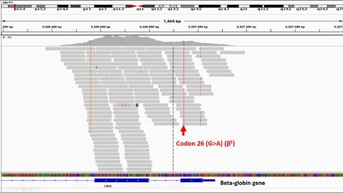 Figure 5. The sample was called as homozygous Hb E by whole exome sequencing, but it was compound heterozygous mutation of 3.48 kb deletion and codon 26 (G > A) (βE) by PCR. Codon 26 (G > A) (βE) from the remaining chromosome was called from all reads.