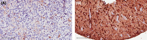Figure 3. Protein levels of FGF2 in tumor samples from proneural gliomas detected by immunohistochemistry. The protein levels of cytoplasmic FGF2 ranged from moderate in 2–10% of the tumor cells (A) to strong in 51–75% of the tumor cells (B) in the tumor samples. Scale bars represent 0.1 mm.