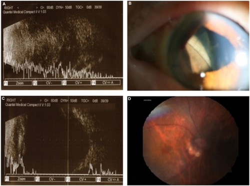 Figure 1 Changes in suprachoroidal hemorrhage with time.