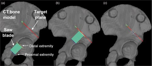 Figure 3. Navigated freehand cutting process within the pelvis. (A) While the oscillating saw is tracked in the operating room by an optical localizer, the real-time visual feedback consists of continuously refreshing both the position and orientation of the saw blade relative to the 3D CT model of the simulated bone. The target plane is represented by a red line. The blade is represented by a green rectangle delimited by a yellow line (the distal extremity of the blade) and a blue line (the proximal extremity of the blade). (B) The distal extremity of the blade is positioned on the bone surface on the target plane since the yellow line overlaps the red line. (C) The blade is correctly aligned on the target plane since the red, yellow and blue lines overlap perfectly.