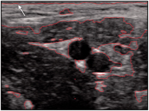 Figure 1. Diagnostic ultrasound image of the target vessel and surrounding tissue used for the determination of the treatment planning model parameters. The target vessel was the femoral artery of a FH pig used in the study described in Shehata et al. [Citation65]. Reproduced with permission from Almekkawy [Citation111]. S, skin; F, fat; M, muscle; CT, connective tissue; A, artery.