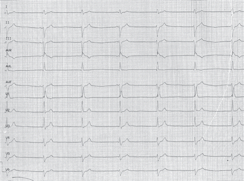 Fig. 1. Sinus node bradycardia with sino-atrial block and junctional rhythm escape. Wide QRS (130 ms) with right block bundle branch block and left anterior hemiblock. Heart rate: 39 beats/min.