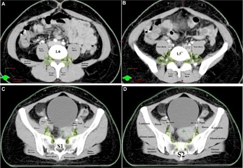 Figure 1 Cranial to piriformis portion of lumbosacral plexus (L4, L5, S1, and S2).