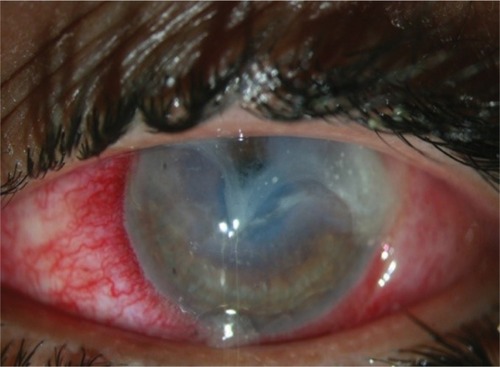 Figure 2 Left eye at presentation (primary position).