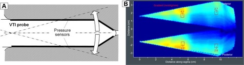 Figure 6 (A) VTI probe elevation to acquire tactile feedback from deep structures and (B) a tactile image for VTI probe elevation inside a silicone model with known elasticity distribution.