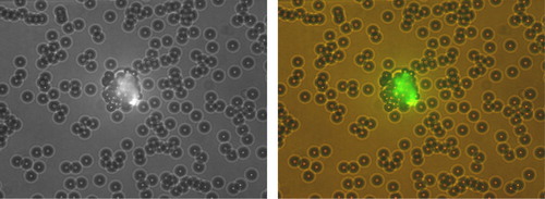 Figure 1.  Epifluorescent micrograph of a circulating endothelial cell (Zeiss; 20× objective) stained bright green with Ulex Europeus lectin and rosetted by several anti-human CD146-coated beads (4.5 µm each).