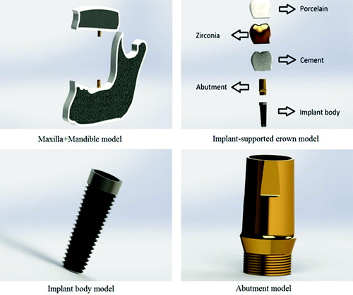 Figure 1. Maxilla and mandible, implant-supported crown, implant body and abutment model.