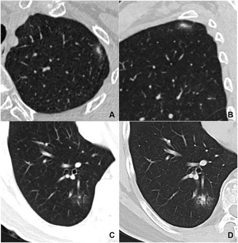 Figure 4 Patients with pulmonary cryptococcosis presented as solitary subsolid nodules. (A and B) Axial and sagittal CT images in a 60-year-old asymptomatic woman show an oval and ill-defined mixed GGN with strip shaped solid component located in the left upper lobe. (C and D) Axial CT images in a 50-year-old asymptomatic man show an ill-defined mixed GGN located in the right lower lobe. (D) The solid component in this nodule significantly increases after one month.