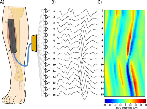 Figure 1. Examples of sEMG signal detection. (A) Representation of the array of 16 electrodes positioned on the Tibialis Anterior muscle (B) 15 single differential signals obtained by the corresponding instrumentation amplifiers. (C) sEMG signals or the same epoch of panel B represented as an interpolated color map.