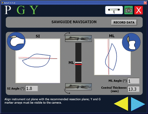 Figure 2. Real-time navigation screen for the computer-assisted technique. The current sawguide position and orientation (in red) are shown relative the resection goal (in black). Information is provided both visually and numerically. The SI view is relatively easy for the user to understand because the left/right rotations of the physical sawguide correspond to left/right rotations of the visual image. Since the ML view is along the leg, the mental mapping between the sawguide movements and the virtual representation is less obvious, and they were therefore represented in two different visual manners: in the center of the display, as the user moves the back of the sawguide up and down (thus changing the orientation in the ML plane), the red bar moves up and down accordingly; on the right is the schematic view. The blue circles show the orientation of the everted patella relative to the femur for the SI (left) and ML (right) views. The “G” marker array was mounted on the sawguide and the “Y” marker array was mounted on the patellar bone; both needed to be visible for the navigation to occur. “P” refers to the digitizing pointer used in earlier steps. The text at the bottom of the screen provides guidance to the user, although the users never needed this beyond the initial training.