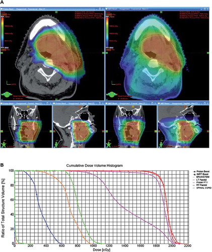 Figure 1. This shows a comparison of an intensity-modulated radiotherapy (IMRT) plan and a proton therapy (PT) plan for a 46-year-old female with a spindle cell carcinoma involving the right maxillary sinus (pT4N0) with involvement of the infraorbital nerve, the orbit, the pterygomaxillary space, and the infratemporal fossa, status post endoscopic maxillectomy, rhinotomy, and orbital decompression. For both plans, the prescribed dose to the primary target was 74.4 Gy/CGE in 1.2 Gy/CGE twice-daily fractions. The low neck was also prescribed 50 Gy in 2 Gy fractions with 6 MV photons with concurrent weekly cisplatin during radiation therapy.Figure 1A shows color-wash depictions of the dose distributions achieved with the PT plan (left) and the IMRT plan (right). As apparent from the axial, coronal, and sagittal images, there is greater integral dose with the IMRT plan. Figure 1B shows the dose-volume histogram (DVH) comparison between the two plans; as apparent from the curves on the far right, the target coverage was the same for the two plans, but the PT plan delivered a significantly lower dose to the optic structures, including the chiasm, the lacrimal glands, the retinae, and the optic nerves as well as the brainstem and parotids. The differences in dose to these structure are further detailed in Table II.