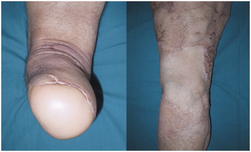 Figure 5. No skin retraction was observed following a free dorsalis pedis fillet flap coverage for the wide defect of the right popliteal fossa.