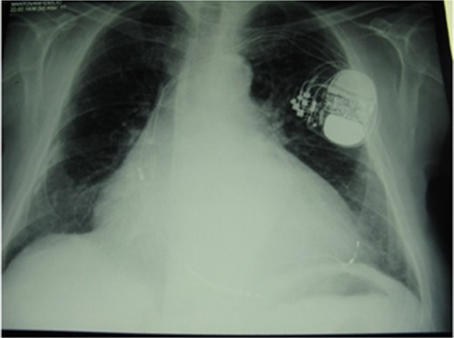 Figure 7 X-ray shows an implantable cardiac defibrillator/pacemaker following heart surgery.
