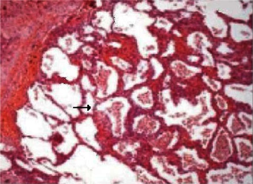 Figure 2 Pulmonary veno-occlusive disease reveals multiple septae with fibrinous exudates.