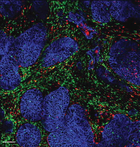 Figure 1. Distribution of T cells, macrophages and tumor cells within a human lung tumor. Tumor cells (blue, stained for EpCAM) are organized into compact islets surrounded by T cells (green, stained for CD3) and macrophages (red, stained for CD206) which are often in contact. Bar, 100 µm.