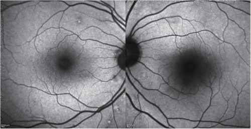 Figure 4 Autofluorescence at the initial visit. The right and left eye exhibited no abnormal hyperfluorescence in the macular area.