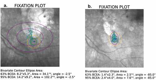 Figure 2. Progression of fixation training. The patient’s fixation parameters are identified as P1 (green circle), P2 (yellow circle), 63% BCEA (smaller purple circle) and 95% BCEA (larger purple circle). Image a represents fixation at the start of training and image b demonstrates the fixation progress toward the end of the training. Also note the TRL location is highly reproducible throughout the training.