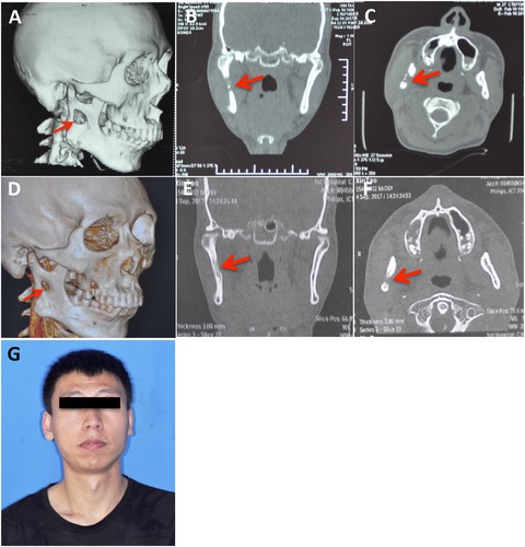 Fig. 7 Follow-up material of the HNTB patient—the case report. a–c Computed tomography results after two months of treatment. d–f Computed tomography results after ten months of treatment. g Frontal photograph after ten months of treatment. Red arrow: mandibular involvement