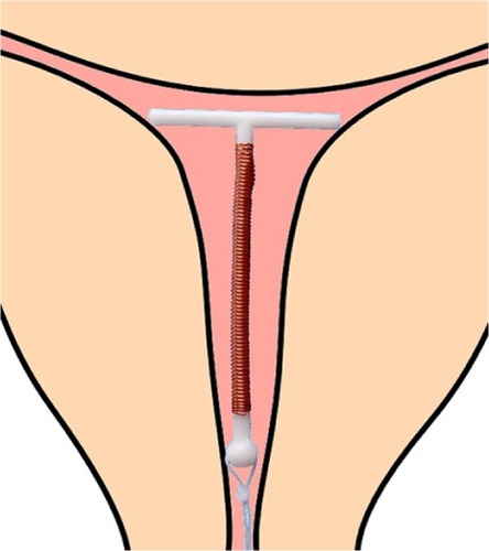 Figure 3 Adapted T-shape intrauterine device with transverse arm of 18 mm.