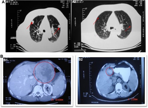 Figure 4 (A) The abscopal effect of UMIPIC in an HCC patient; (B) local effect of UMIPIC in an HCC patient.