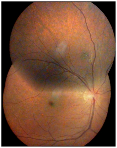 Figure 3 Appearance of the retina 3 weeks after treatment was commenced. Both the retinal detachment and disk edema have resolved.