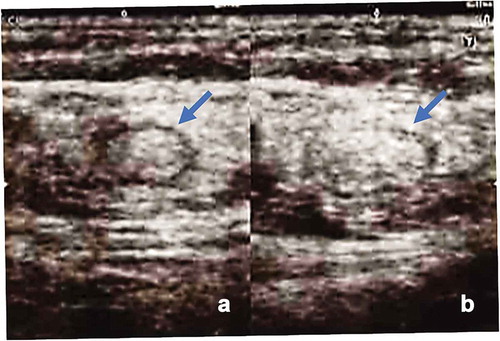 Figure 4. Intranodal administration of DC vaccine into unaffected groin lymph nodes (LNs) using direct ultrasound guidance provided by a skilled doctor. Left panel: the groin LNs before vaccine administration. Right panel: the same LNs after vaccine injection, showing swelling of the LNs