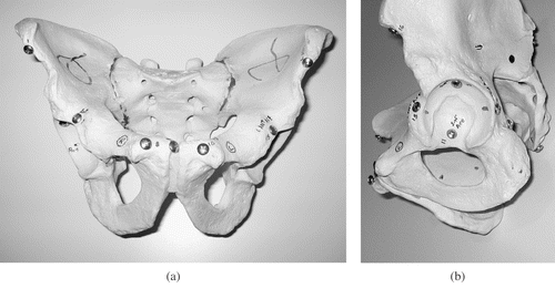 Figure 1. Anteroposterior (a) and lateral (b) views of a plastic pelvic model with aluminum screws inserted in predetermined anatomical points around the pelvis and acetabulum.