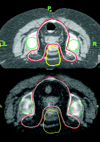 Figure 1.  Typical MVCT image-guidance for deep seated rectal cancer. Upper figure depicts the simulation CT with target and structure outlines (CTV in white, PTV in red, femoral heads in green, anterior dose tuning structure in yellow); the relationship between target volume and bony patient anatomy is apparent. The lower figure represents a corresponding image-guidance MVCT following set-up correction. The simulation CT derived structure outlines are superimposed onto the MVCT.