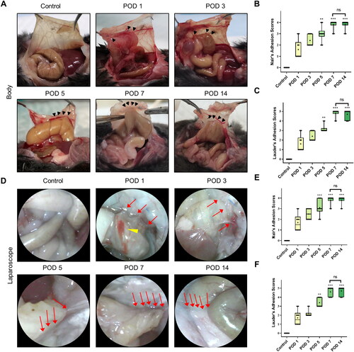 Figure 3. Dynamic visual observation of the process of adhesion evolution by laparoscopy. (A) Open surgical observation of normal peritoneum and PAA conditions on PODs 1, 3, 5, 7 and 14; black arrows mark adhesion tissue (n = 60). (B) Nair’s adhesion scores at different time points under typical gross observation (n = 10; compared with the control group, *P < 0.05). (C) Lauder’s adhesion scores at different time points under typical gross observation (n = 10; compared with the control group, *P < 0.05). (D) Representative images of abdominal adhesion formation in the injured areas visualized by laparoscopy (n = 60, yellow arrows indicate subserosal hemorrhage on the injured cecal surface, and red arrows indicate tight flaky adhesion of the cecum to the abdominal wall). (E) Nair’s adhesion scores at different time points under laparoscopy (n = 10; compared with the control group, *P < 0.05, ***P<0.001). (F) Lauder’s adhesion scores at different time points under laparoscopy (n = 10; compared with the control group, *P < 0.05, ***P<0.001).